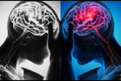 Top Scientist Faulty Brain Wire Causes Ear Ringing